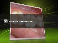 Tooth Colored Fillings video thumbnail image